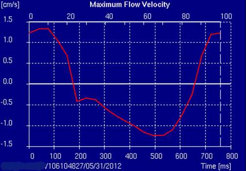 Phase Trigger [ns] Area [mm 2 ] Area [pix] Vel [cm/s] SD Vel [cm/s] Min V [cm/s] Max V [cm/s] Flow [ml/s] Πίνακας 4.1.