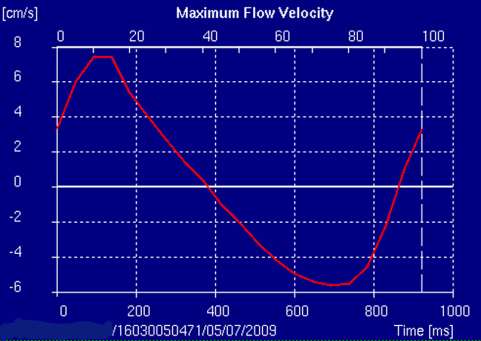 Phase Trigger [ns] Area [mm 2 ] Area [pix] Vel [cm/s] SD Vel [cm/s] Min V [cm/s] Max V [cm/s] Flow [ml/s] Πίνακας 4.2. Μέγιστη (9,08 cm/sec) και ελάχιστη ( 6,63 cm/sec) ταχύτητα ροής σε ένα πλήρη καρδιακό κύκλο για ασθενή.
