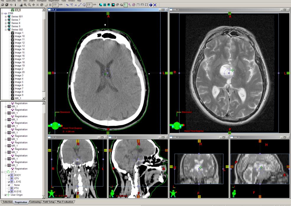 Σε αυτόν τον τρόπο σύντηξης εικόνων η θέση και το σώμα του ασθενούς μπορούν να αλλάξουν και το αποτέλεσμα βασίζεται στην ευθυγράμμιση των δύο εικόνων με την χρήση του λογισμικού.