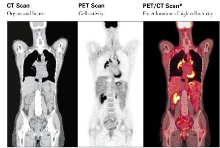 Εικόνα 1: Υβριδικό μηχάνημα PET-CT (Hardware- based fusion) Εικόνα 2: Αποτέλεσμα σύντηξης απεικονιστικών δεδομένων PET-CT Ο δεύτερος τρόπος σύντηξης απεικονιστικών δεδομένων, και αυτός που εξετάσαμε