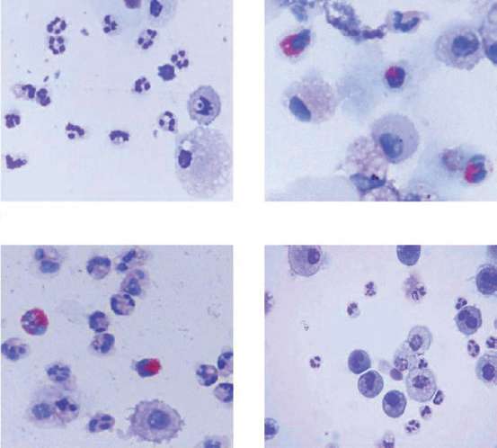 Inflammatory Subtypes in