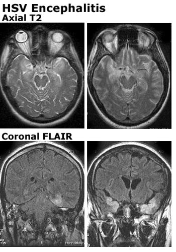 Διάγνωση MRI εγκεφάλου η εξέταση
