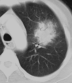 Διάγνωση CT SCAN Halo sign Non-specific consolidation D0 96% D0 D3 68% D3 31% D7 22% D7