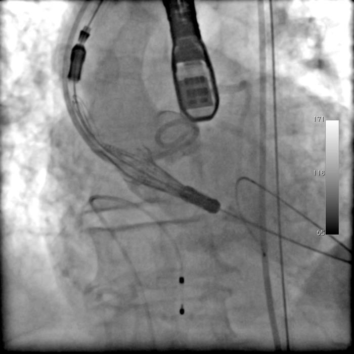 ACURATE neo/tf Procedure Steps