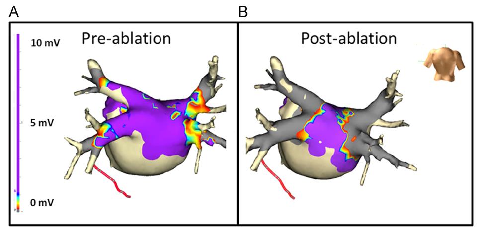 LA wall debulking could be a part of the cryoballoon efficacy beyond