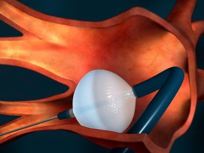 Background: Completed occlusion of right inferior pulmonary vein (RIPV) during cryoballoon ablation is often challenging.