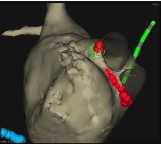 Circ Arrhythm Electrophysiol.