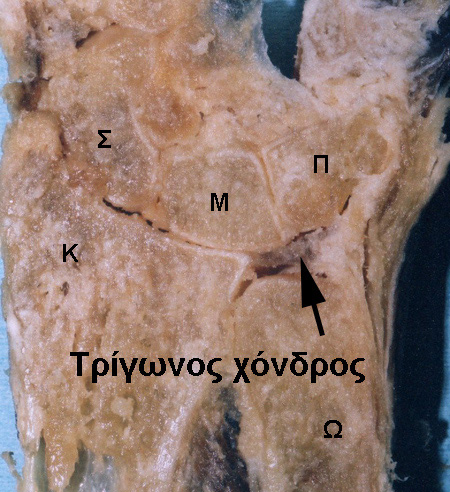 Εικ. 6.4: Στεφανιαία τομή σε ανατομικό παρασκεύασμα πηχεοκαρπικής άρθρωσης. Διακρίνεται ο τρίγωνος χόνδρος (βέλος) ανάμεσα στην ωλένη και τον πρώτο στοίχο του καρπού.
