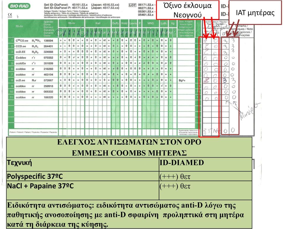 (+++) θετ Ειδικότητα αντισώματος: ειδικότητα αντισώματος anti-d λόγω της