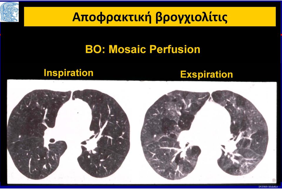 Mosaic Perfusion