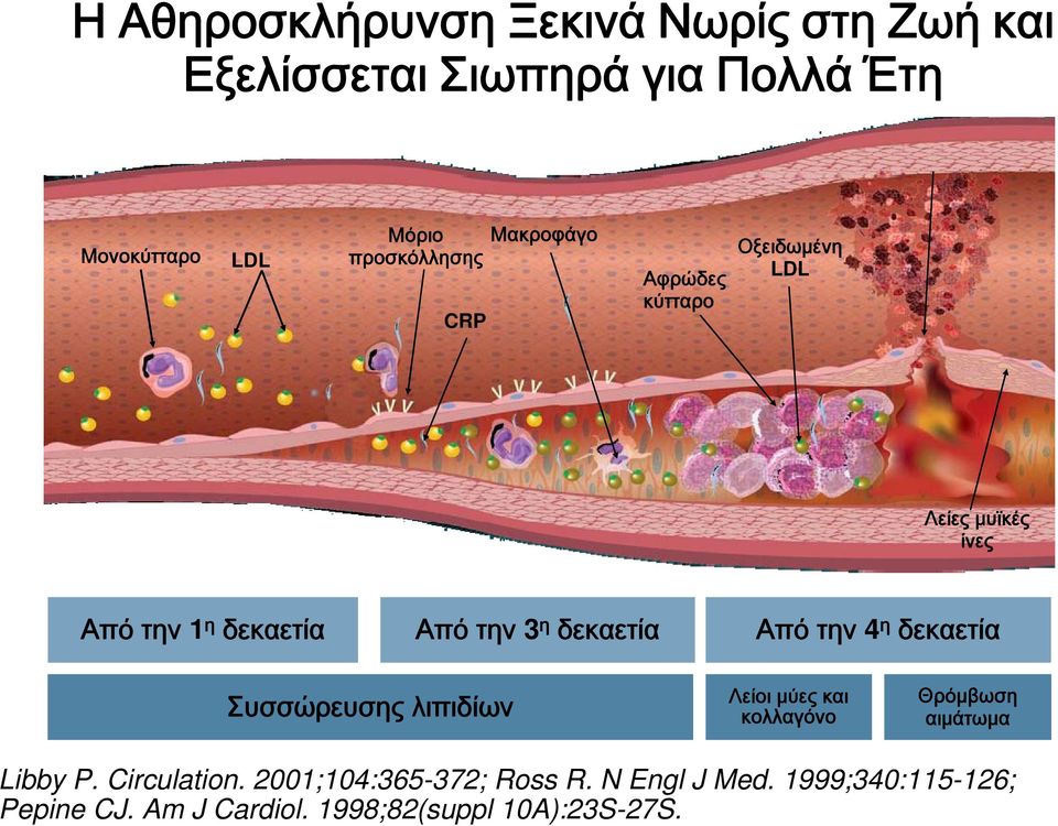 δεκαετία Από την 4 η δεκαετία Συσσώρευσης λιπιδίων Λείοι μύες και κολλαγόνο Θρόμβωση αιμάτωμα Libby P.