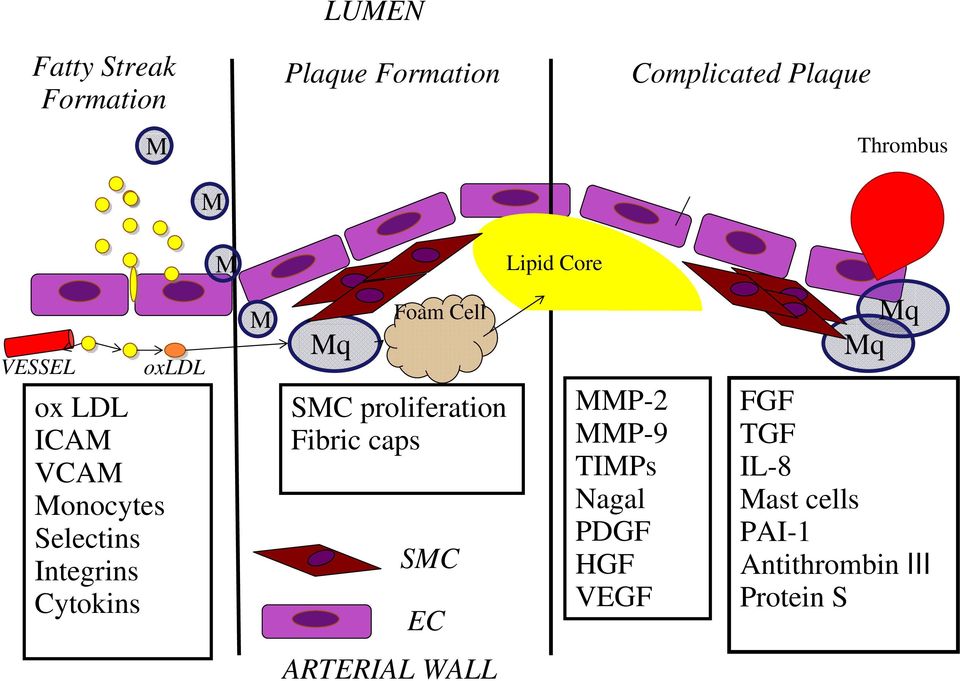 Mq Foam Cell SMC proliferation Fibric caps SMC EC MMP-2 MMP-9 TIMPs Nagal PDGF