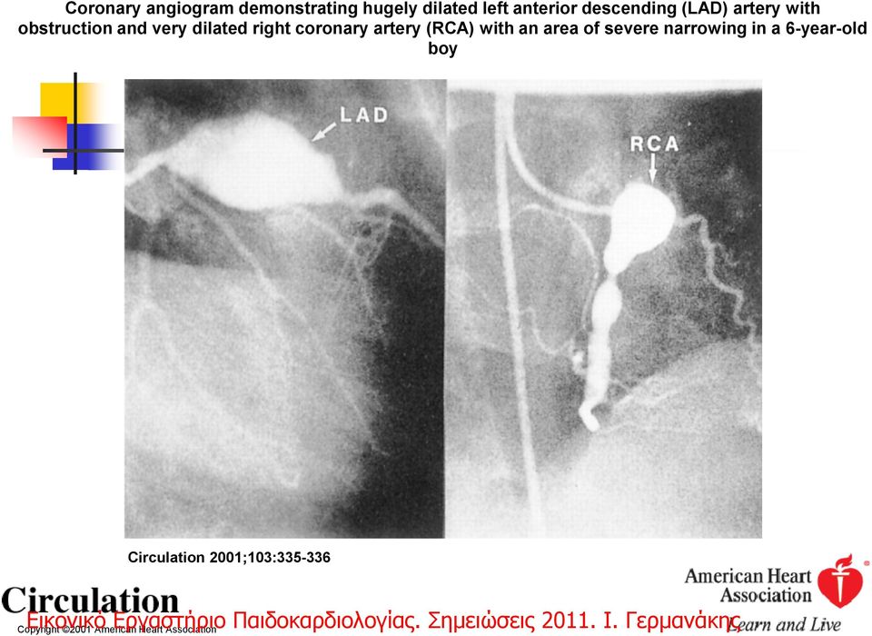coronary artery (RCA) with an area of severe narrowing in a