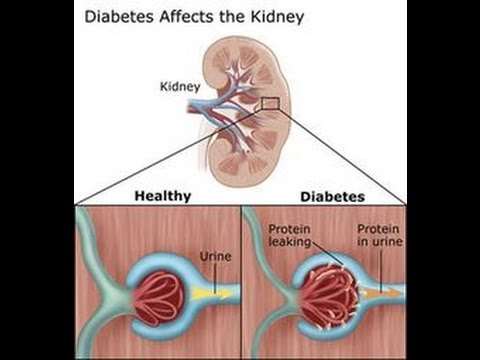 Διατροφική παρέμβαση σε ασθενή με διαβητική νεφροπάθεια (μελέτη