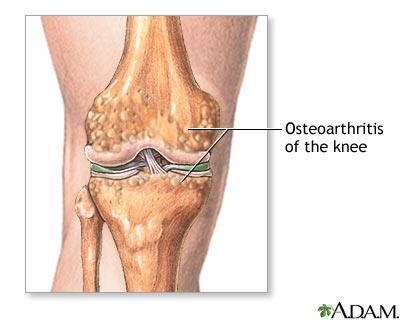 Εισαγωγή - υπόβαθρο Λύση: Ολική αντικατάσταση γόνατου(tkr) περίπου 250,000 αμερικάνοι δέχονται εμφυτεύματα στο γόνατο κάθε χρόνο.