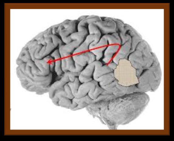 ΑΙΣΘΗΤΙΚΗ ΔΙAΦΛΟΙΙΚΗ ΑΦΑΣΙΑ (ΤRANS-CORTICAL SENSORY APHASIA ΤΗΝ ΣΥΝΑΝΤΟΥΜΕ ΣΕ: