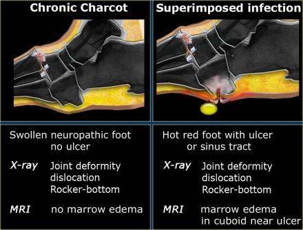 ΧΡΟΝΙΑ ΦΑΣΗ CHARCOT ΧΡΟΝΙΑ ΦΑΣΗ CHARCOT MΕ ΟΣΤΕΟΜΥΕΛΙΤΙΔΑ Οιδηματώδες νευροπαθητικό πόδι χωρι ς