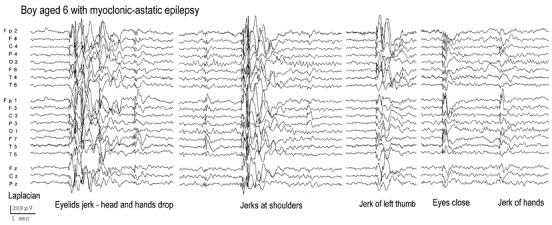 Ιδιοπαθή επιληπτικά σύνδρομα 87 ατονικούς σπασμούς. Το μυοκλονικό ατονικό status epilepticus μπορεί να επαναληφθεί αρκετές φορές κατά τη διάρκεια μιας περιόδου 1 2 ετών [193]