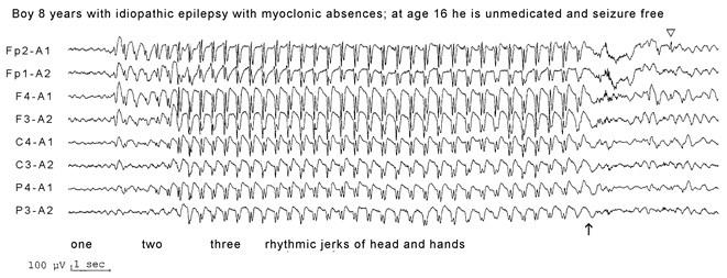 Ιδιοπαθή επιληπτικά σύνδρομα 91 8.4.3.