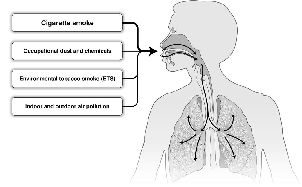 Global Strategy for Diagnosis, Management and Prevention of COPD Risk Factors for COPD Genes