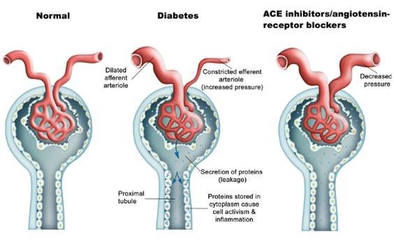 Ευεργετική δράση των αναστολέων του μετατρεπτικού ενζύμου στη διαβητική νεφροπάθεια Diabetes