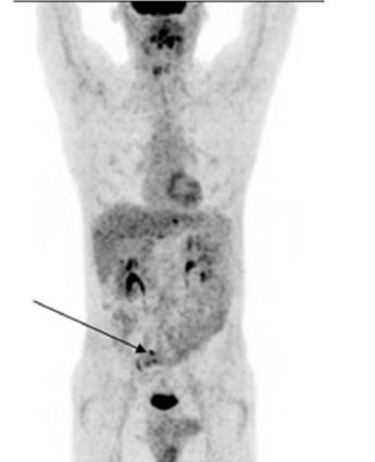 MGUS Διαφορική διάγνωση MRI, focal infiltration Οστικός έλεγχος FDG PET-CT 18-F PET-CT