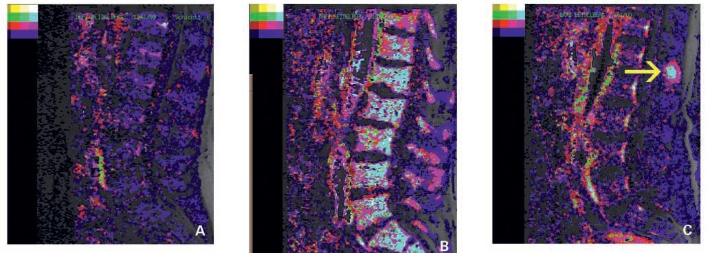 MGUS Διαφορική διάγνωση Οστικός έλεγχος Dynamic Contrast Enhanced MRI (DCE-MRI): ελέγχει παραμέτρους της μικροκυκλοφορίας ώστε να ταυτοποιηθεί το angiogenic switch που συμβαίνει όταν το πρόδρομο