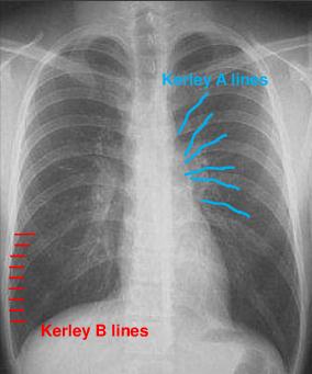 Επιμήκεις γραμμές (2-6cm) που κατευθύνονται στην περιφέρεια από την πύλη του πνεύμονα