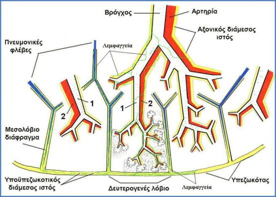 Λεμφαγγειακή καρκινωμάτωση Διάχυτη διήθηση και απόφραξη του λεμφαγγειακού δικτύου των πνευμόνων από νεοπλασματικά κύτταρα Περιβρογχαγγειακό (αξονικό)