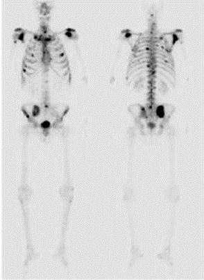 18F fluoride: δείκτης οστεοβλαστικής δραστηριότητας Fluoride PET/CT πιο ευαίσθητη από planar ή SPECT BS (100% vs 70% vs 92%) Επίσης έχει μεγαλύτερη ειδικότητα (97% vs