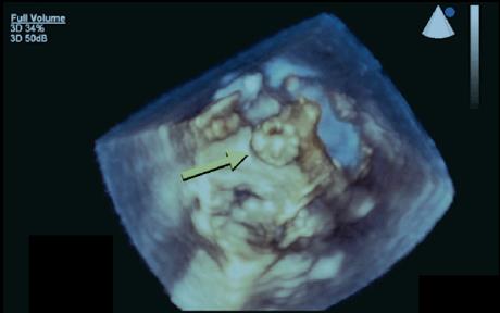 3D TOE vs MDCT for LAA geometry RT3D TOE for the visualization and quantitative analysis of LAA orifice area is