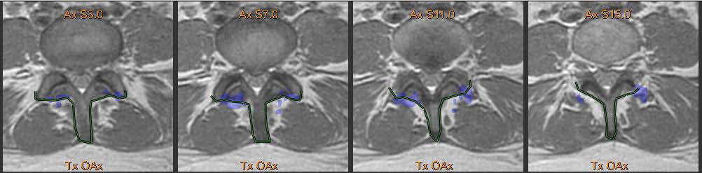 MR-Guided HIFU Axial proton density MR planning images of L4-L5 facet joints.