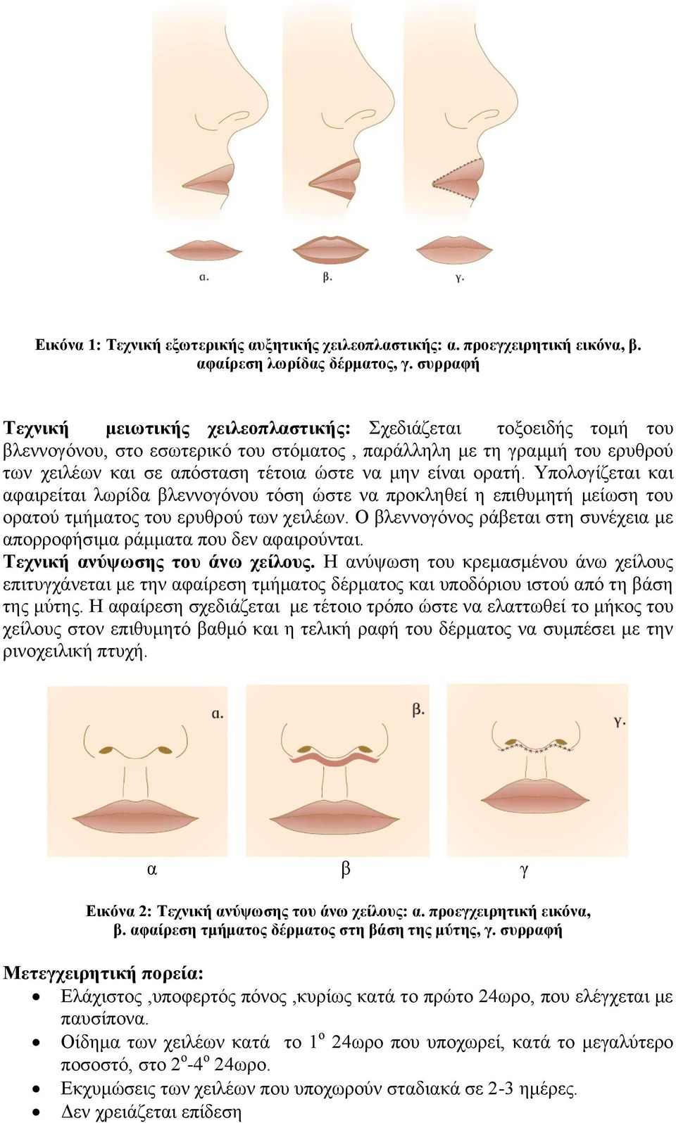 είλαη νξαηή. Υπνινγίδεηαη θαη αθαηξείηαη ισξίδα βιελλνγόλνπ ηόζε ώζηε λα πξνθιεζεί ε επηζπκεηή κείσζε ηνπ νξαηνύ ηκήκαηνο ηνπ εξπζξνύ ησλ ρεηιέσλ.