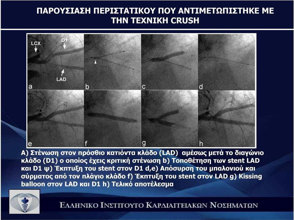 Tοποθέτηση των stent LAD και D1 ψ) Έκπτυξη του stent στον D1 d,e) Aπόσυρση του µπαλονιού και