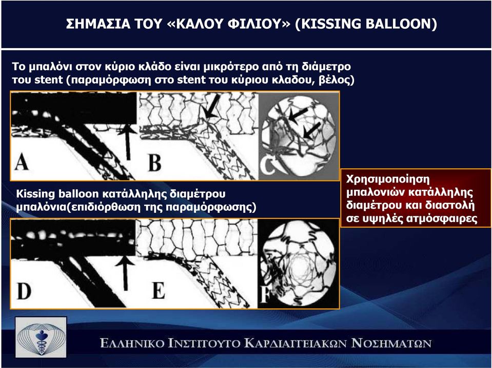 βέλος) Kissing balloon κατάλληλης διαµέτρου µπαλόνια(επιδιόρθωση της