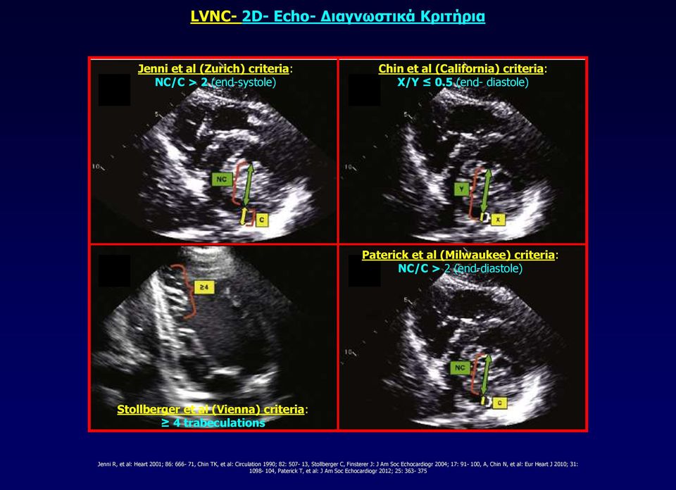 trabeculations Jenni R, et al: Heart 2001; 86: 666-71, Chin TK, et al: Circulation 1990; 82: 507-13, Stollberger C, Finsterer J: J