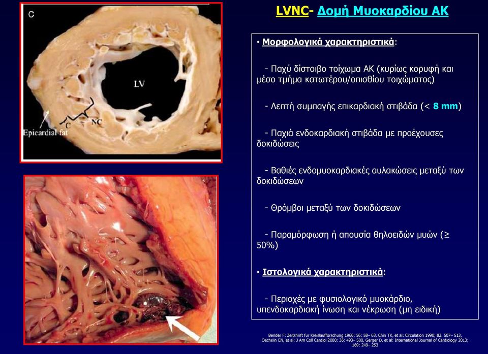 θηλοειδών μυών ( 50%) Ιστολογικά χαρακτηριστικά: - Περιοχές με φυσιολογικό μυοκάρδιο, υπενδοκαρδιακή ίνωση και νέκρωση (μη ειδική) Bender F: Zeitshrift fur Kreislaufforschung 1966;