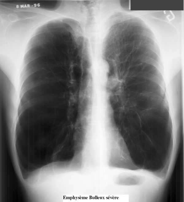 Reduced expiratory flow rate,