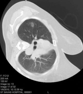 BOOP Percutaneous Ct Guided Localization Of Pulmonary Nodules With Hook Wire Prior To Video Assisted Thoracoscopic Surgery: Our Initial Experience Andriotis E 1, Manouvelou St 1, Stasinopoulou M 1,