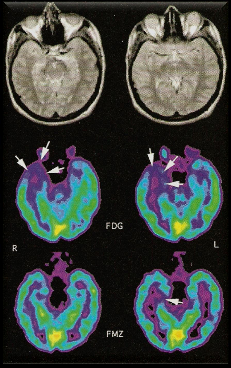 MRI (-). FDG-PET και FMZ-PET σε κροταφική επιληψία. EEG (+).