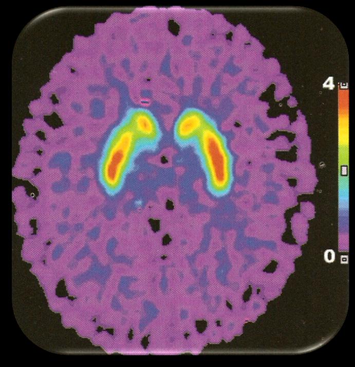 18 F-Fluorodopa PET σε νόσο Parkinson 11 C-raclopride