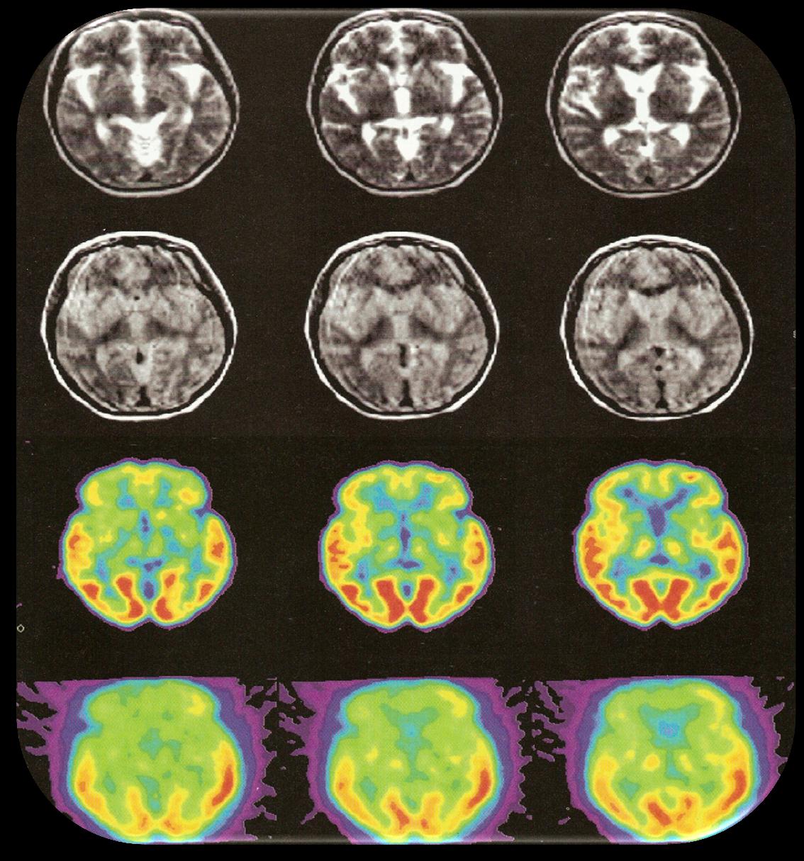 CREUTZFELD- JAKOB MRI: μετωπιαία ατροφία, απεικόνιση βασικών