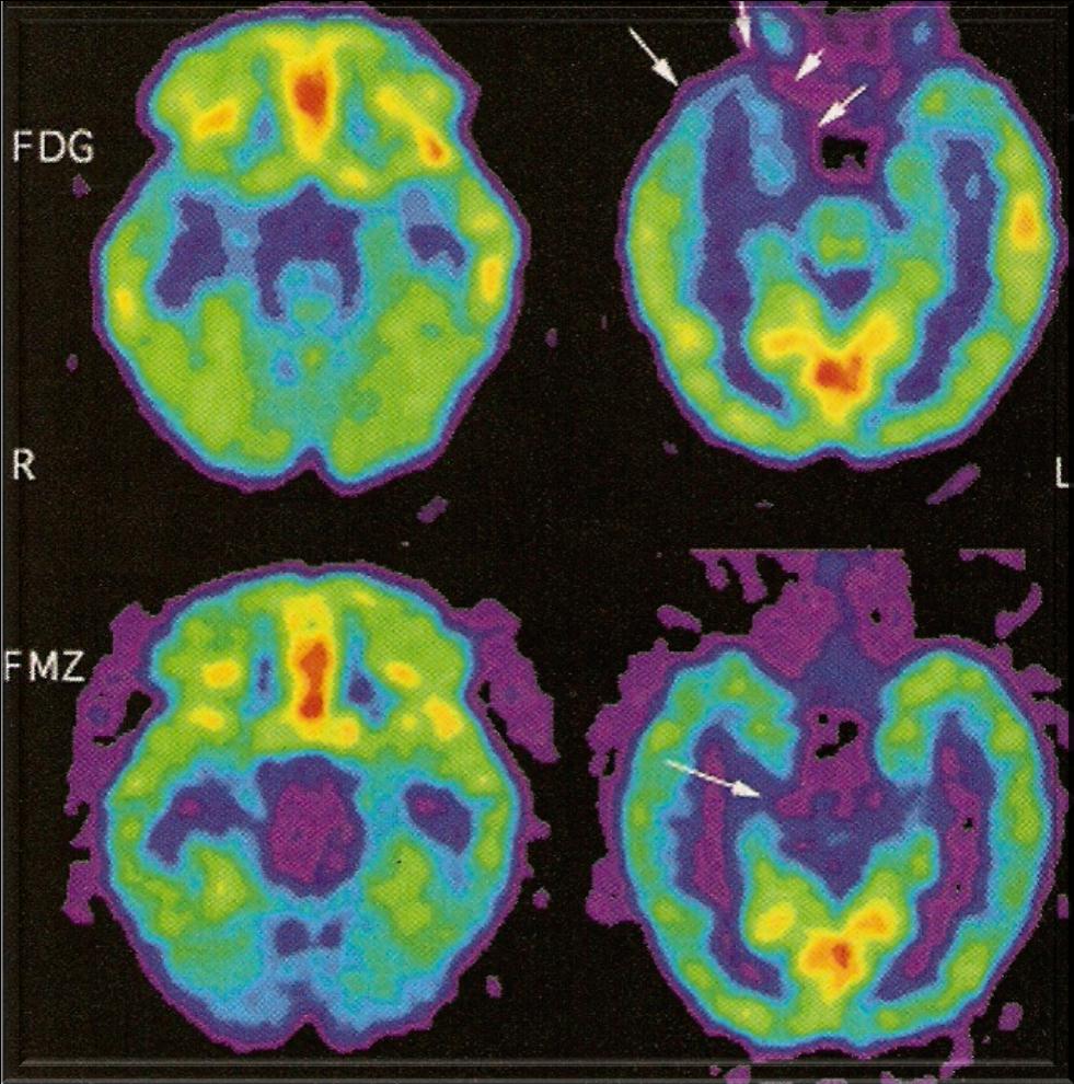 MRI : ατροφία