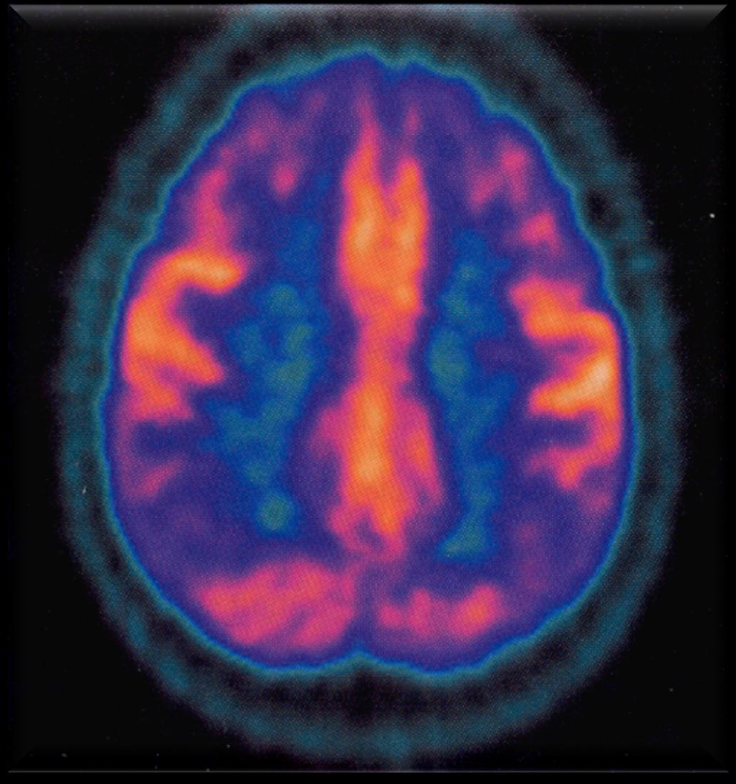 Προχωρημένη νόσος Alzheimer Μειωμένη καθήλωση