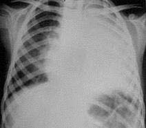 πνευμονική σκίαση και υπεζωκοτική συλλογή σταφυλοκοκκική πνευμονία - αγόρι 7 ετών - υψηλός πυρετός από