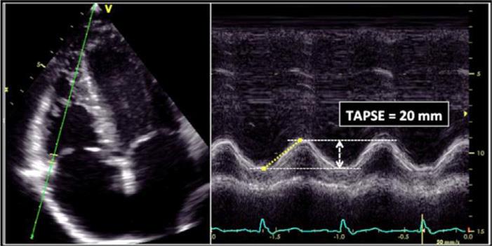 Συστολική Μετακίνηση Επιπέδου ΤΔ- TAPSE Kaul S, et al: Am Heart J 1984; 107: 526-31, Tamborini G, et al: Int J Cardiol 2007; 115: 86-9, Karatasakis GT, et al: Am J Cardiol 1998; 82: 329-34,