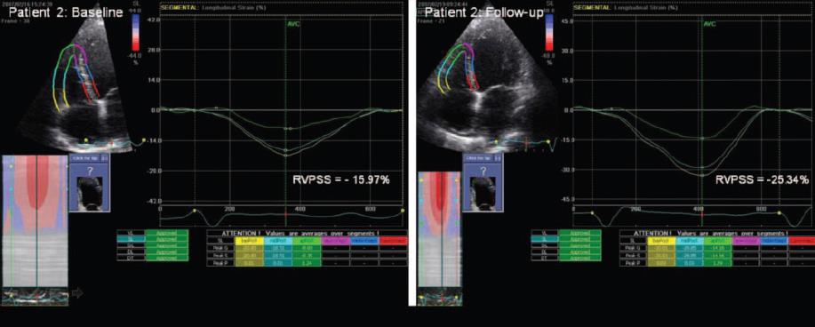 ADHF- Απάντηση ΔΚ σε Εντατική Θεραπεία- 2D-STE- RV Peak Systolic Strain Βελτίωση χαμηλού RV peak systolic longitudinal