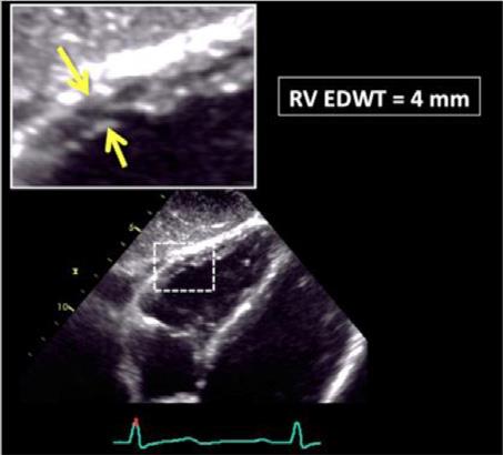 Τοιχωματικό Πάχος ΔΚ (RVWT)- Multi-Ethnic Study of Atherosclerosis (MESA) RV Study Υπερτροφία ΔΚ (RVH): ευαίσθητο βαρόμετρο λειτουργικότητας ΑΚ - Αύξηση μεταφορτίου ΔΚ - RVWT: > 0.