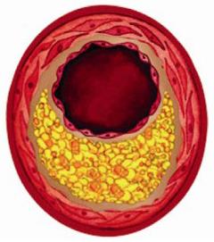 Arterial disease A G I N G atheromatosis - αθηρωμάτωση INFLAMMATION GENOME & CLASSICAL CARDIOVASCULAR DISEASE RISK