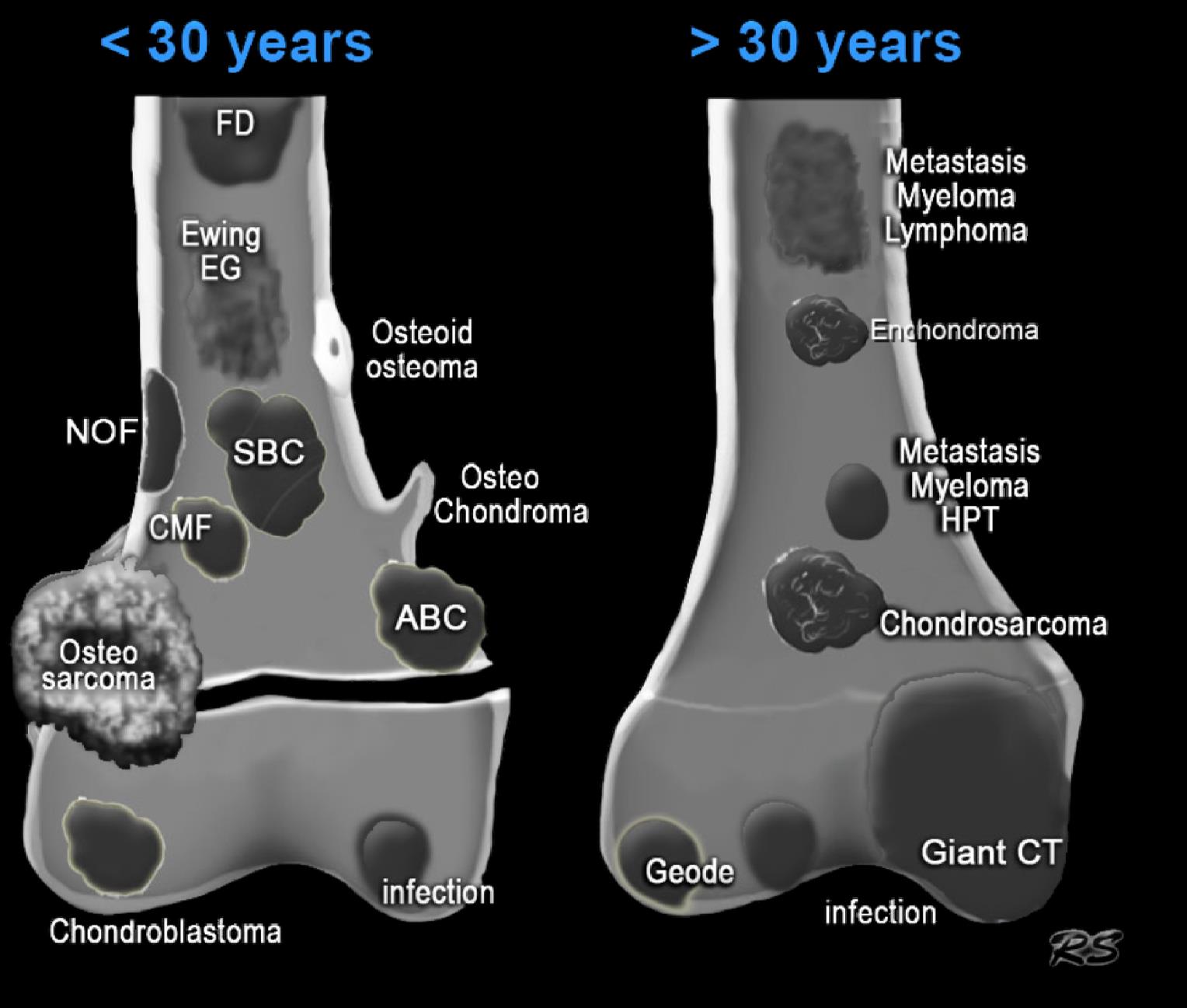 μονήρης οστική κύστη HPT: brown tumor